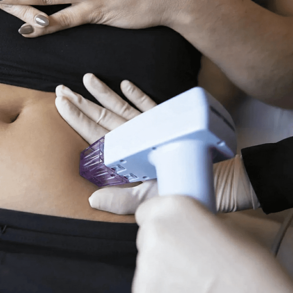 Morpheus8 Large Body Area