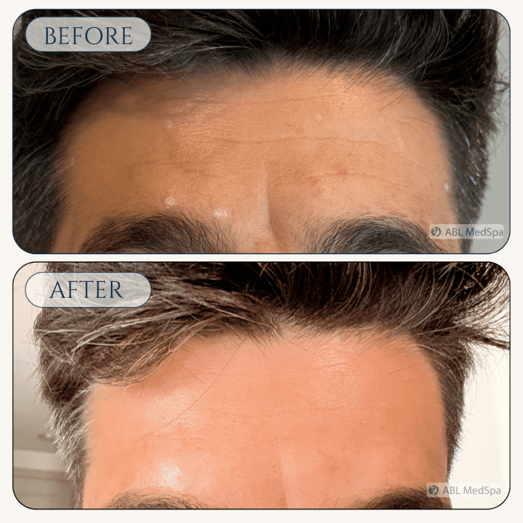 Before and after Wrinkle Relaxers treatment at ABL Med Spa in Round Rock TX