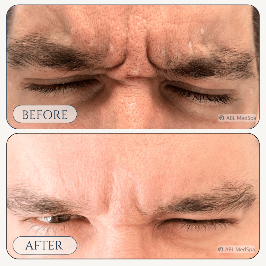 Before and after Wrinkle Relaxers treatment at ABL Med Spa in Round Rock TX