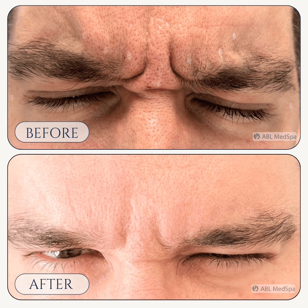 Before and after Botox treatment at ABL Med Spa in Round Rock TX