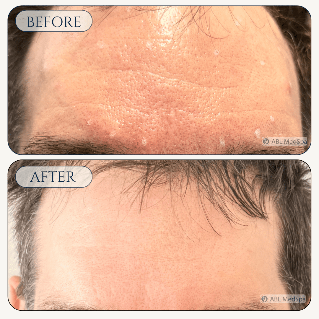 Before and after Botox treatment at ABL Med Spa in Round Rock TX