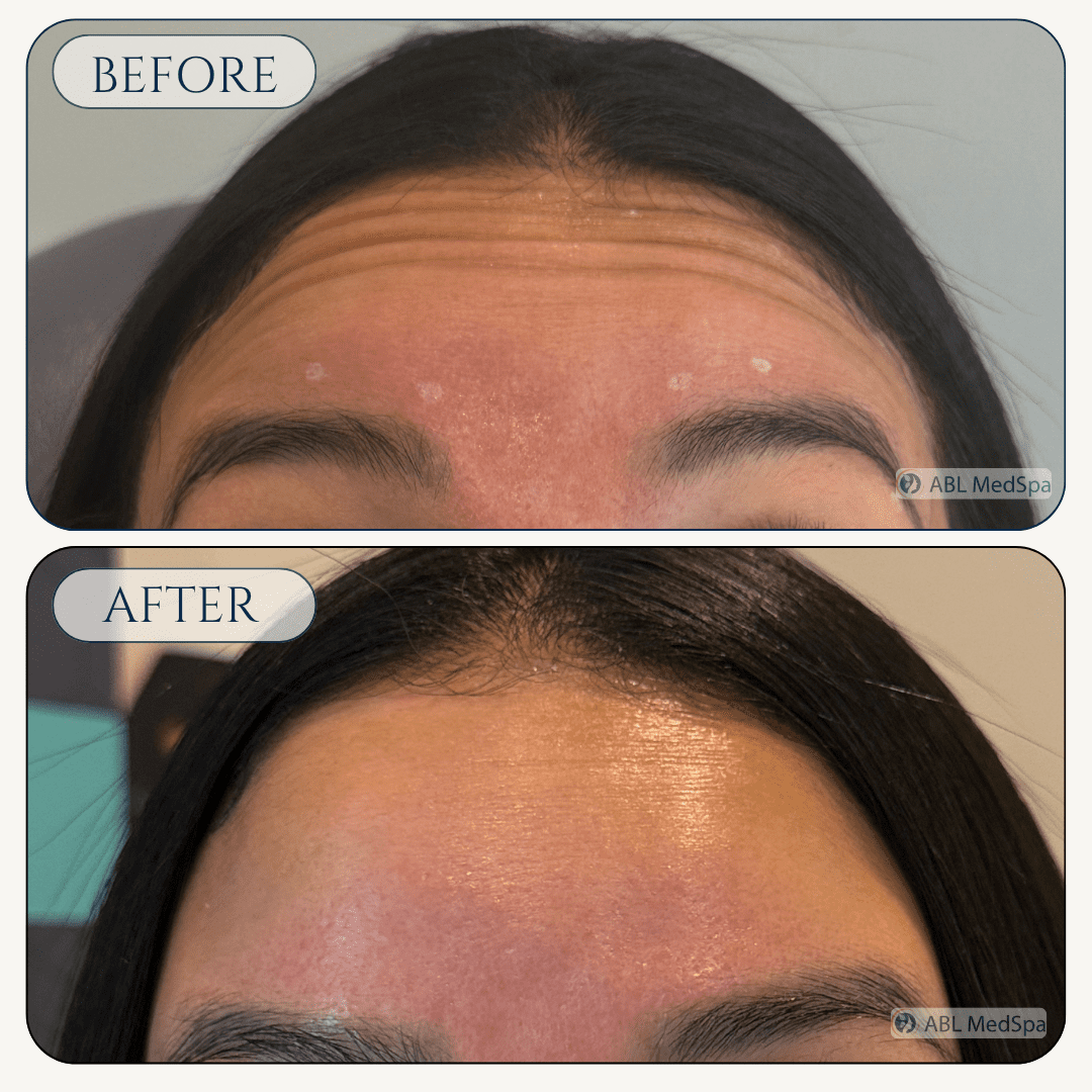 Before and after Botox treatment at ABL Med Spa in Round Rock TX