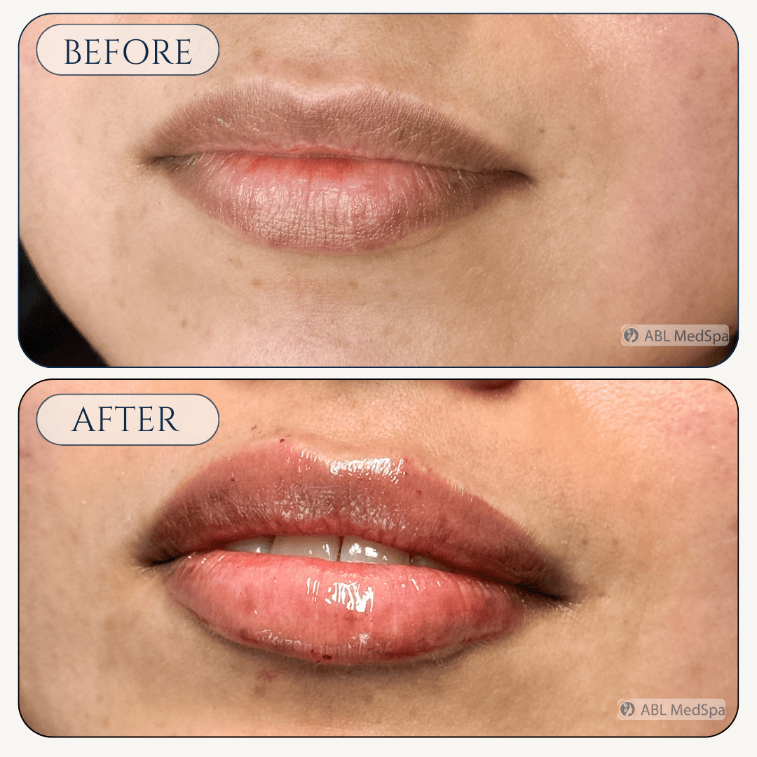 Before and after lip filler treatment at ABL Med Spa in Round Rock TX