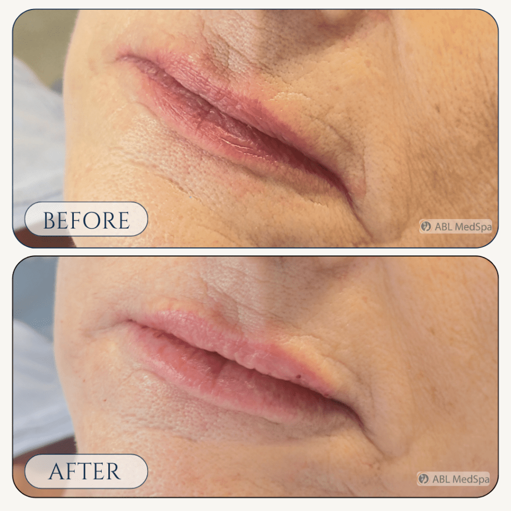 Before and after Lip Fillers treatment at ABL Med Spa in Round Rock TX