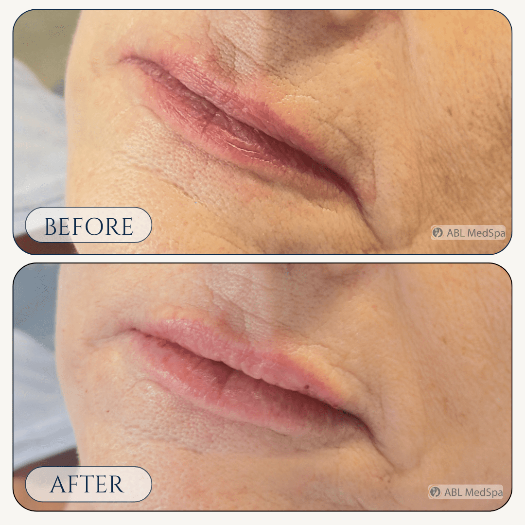 Before and after lip filler treatment at ABL Med Spa in Round Rock TX