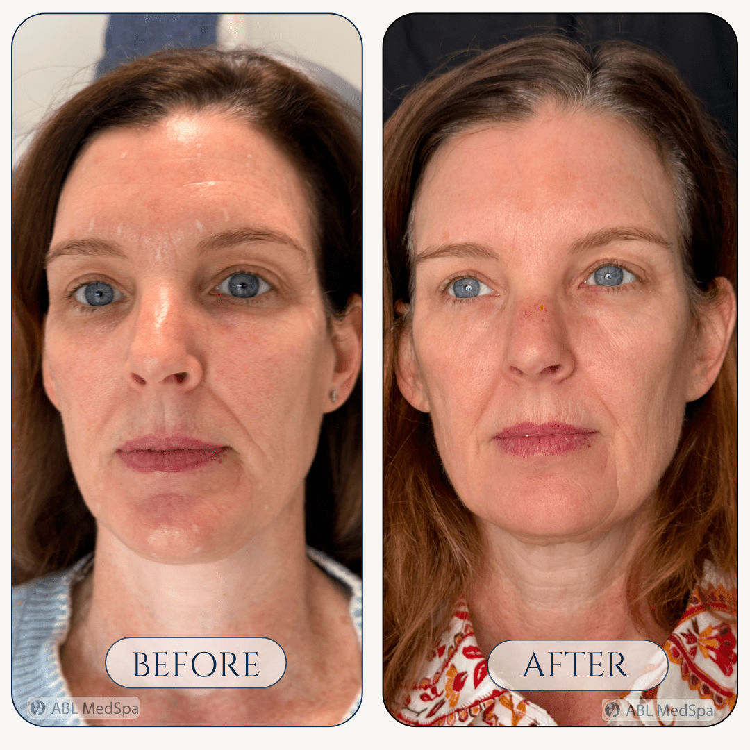 Before and after facial rejuvenation at ABL Med Spa Round Rock TX